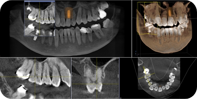 歯科用CTを活用した3D画像による診断