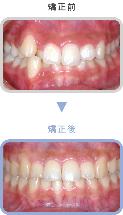 矯正治療