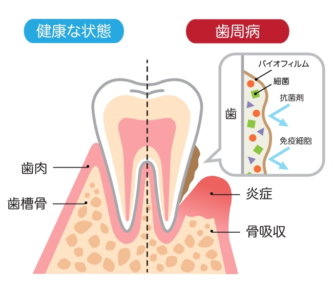 健康な状態・歯周病