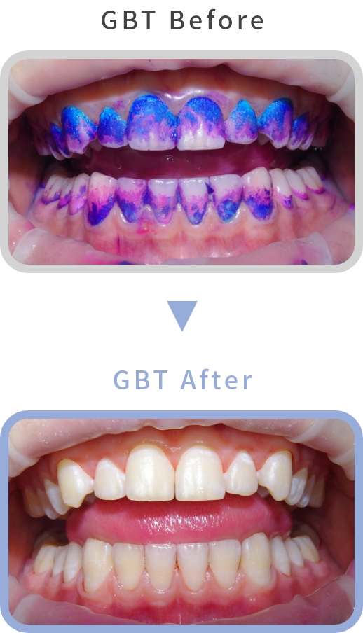 GBT Before GBT After