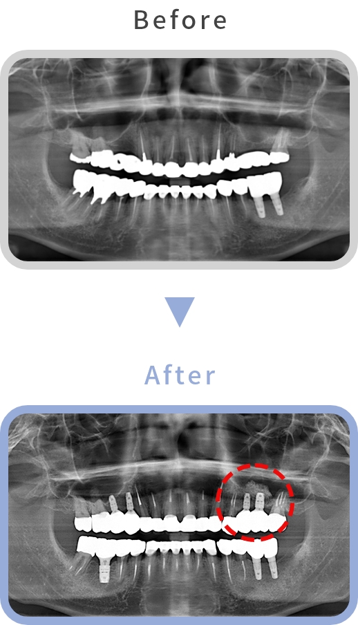 サイナスリフト Before After