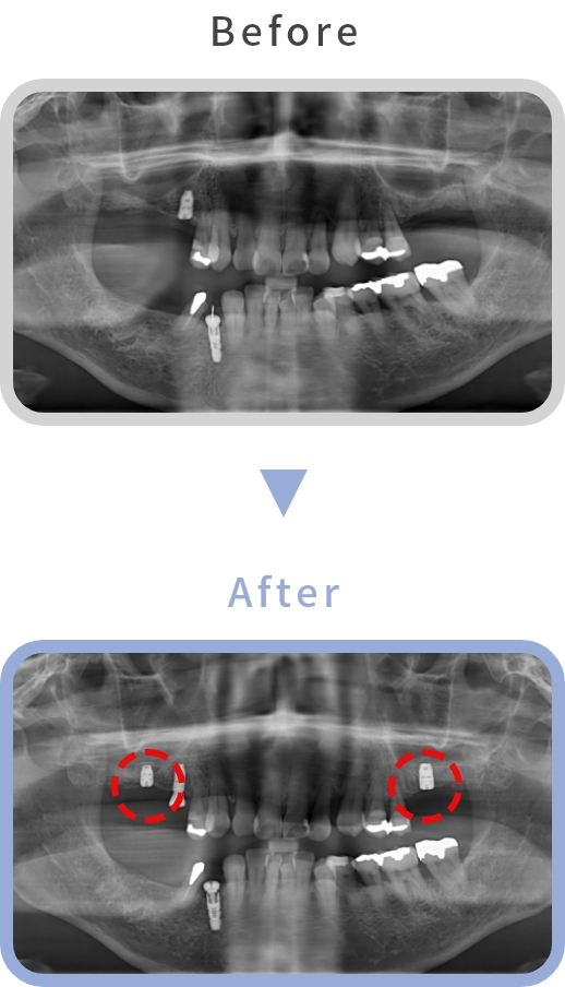 ソケットリフト Before After