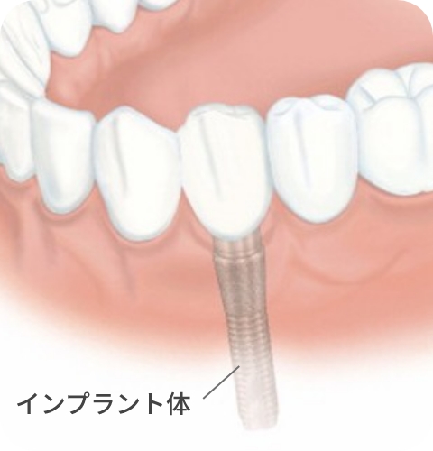 インプラント手術